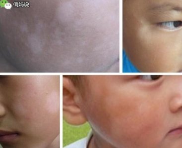 ​仔细看看，你家孩子脸上有这种白斑吗？