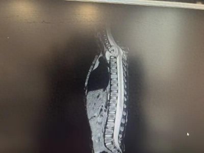 ​华西二院梁益建：感动中国的“驼背救星”，为4岁患儿开展“重度脊柱畸形矫正