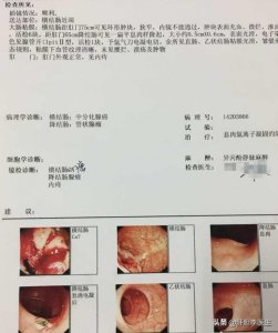​结肠癌晚期 怎么一步一步来治愈？