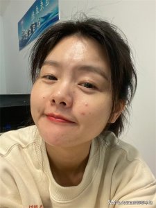 ​美容祛痘 关于痘痘从护肤到去除，一文读懂