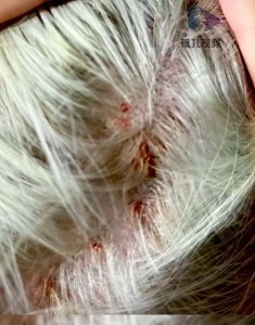 男子花5000元漂染头发致头皮二度烧伤,“事发后发型师消失了,助理也称自己失