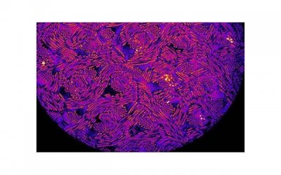 患尖锐湿疣注意性生活节制吗 护理尖锐湿疣患者有哪些注意事项