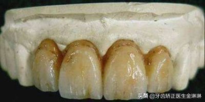 ​什么是氟斑牙？为什么这么多淄博人有？