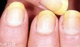 指甲变黄怎么调理 指甲变黄的治疗方法
