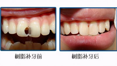 ​牙齿缺损怎么办修复（牙齿缺损该如何修复？不同的情况，修复方式大有不同）