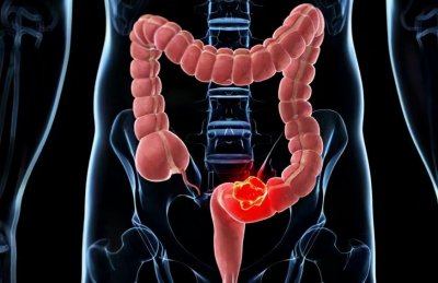 ​“肛门癌”和“痔疮”症状相似，容易混淆，你能不能分清？