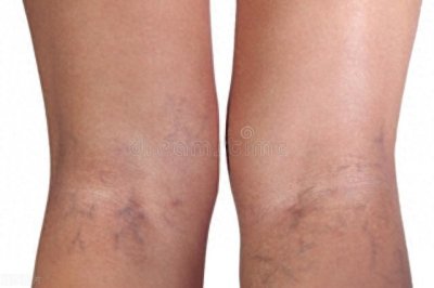​为啥有的女生大腿缝隙很宽，有的就完全没缝隙？医生一次说清