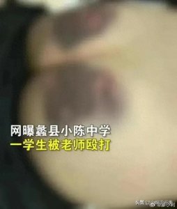 ​教体局调查处理中！孩子屁股被老师打成黑紫色，已无大碍！